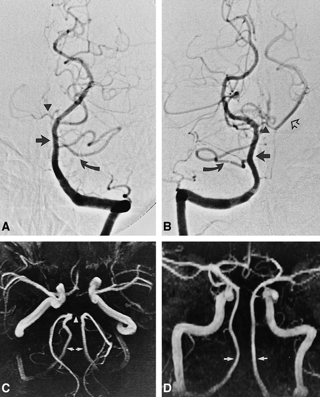 basilar artery fenestration