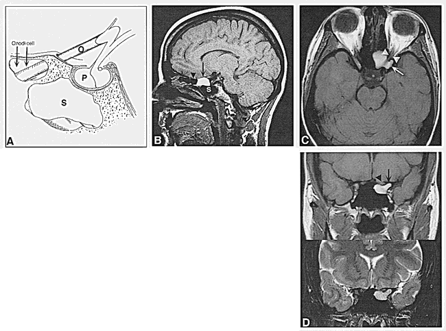 Onodi Cell Ct