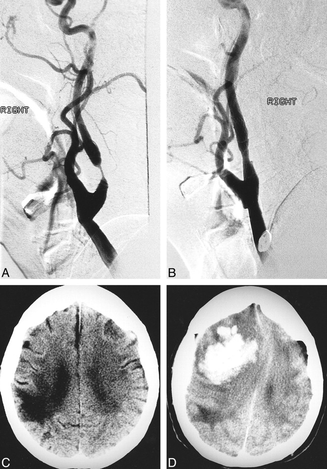 Extracranial Carotid Artery