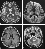 Japanese Encephalitis Patient