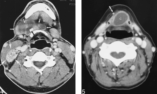Fig 5 The Ct Appearance Of Thyroglossal Duct Carcinoma