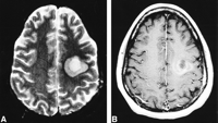 balo concentric sclerosis