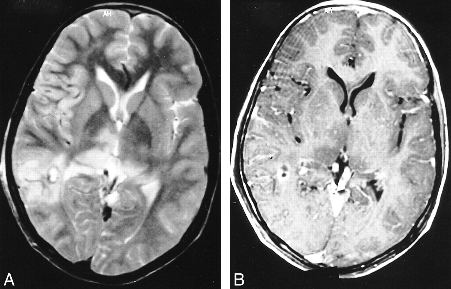 Brain Cyst