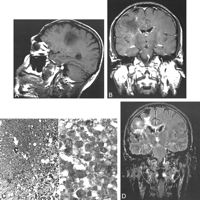 balo concentric sclerosis