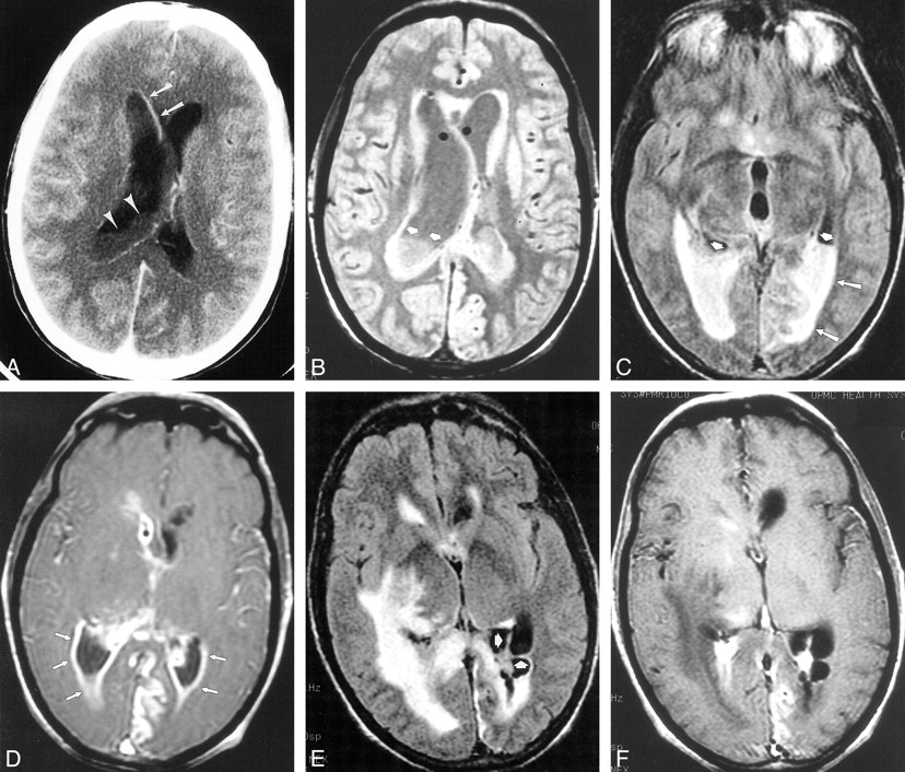 ct scan meningitis