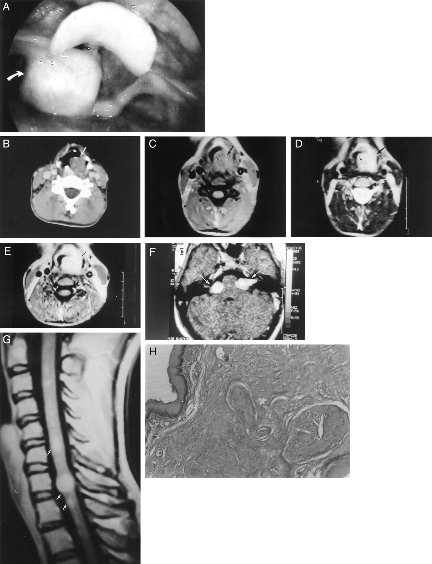 Neurofibromatosis Type 1 And 2