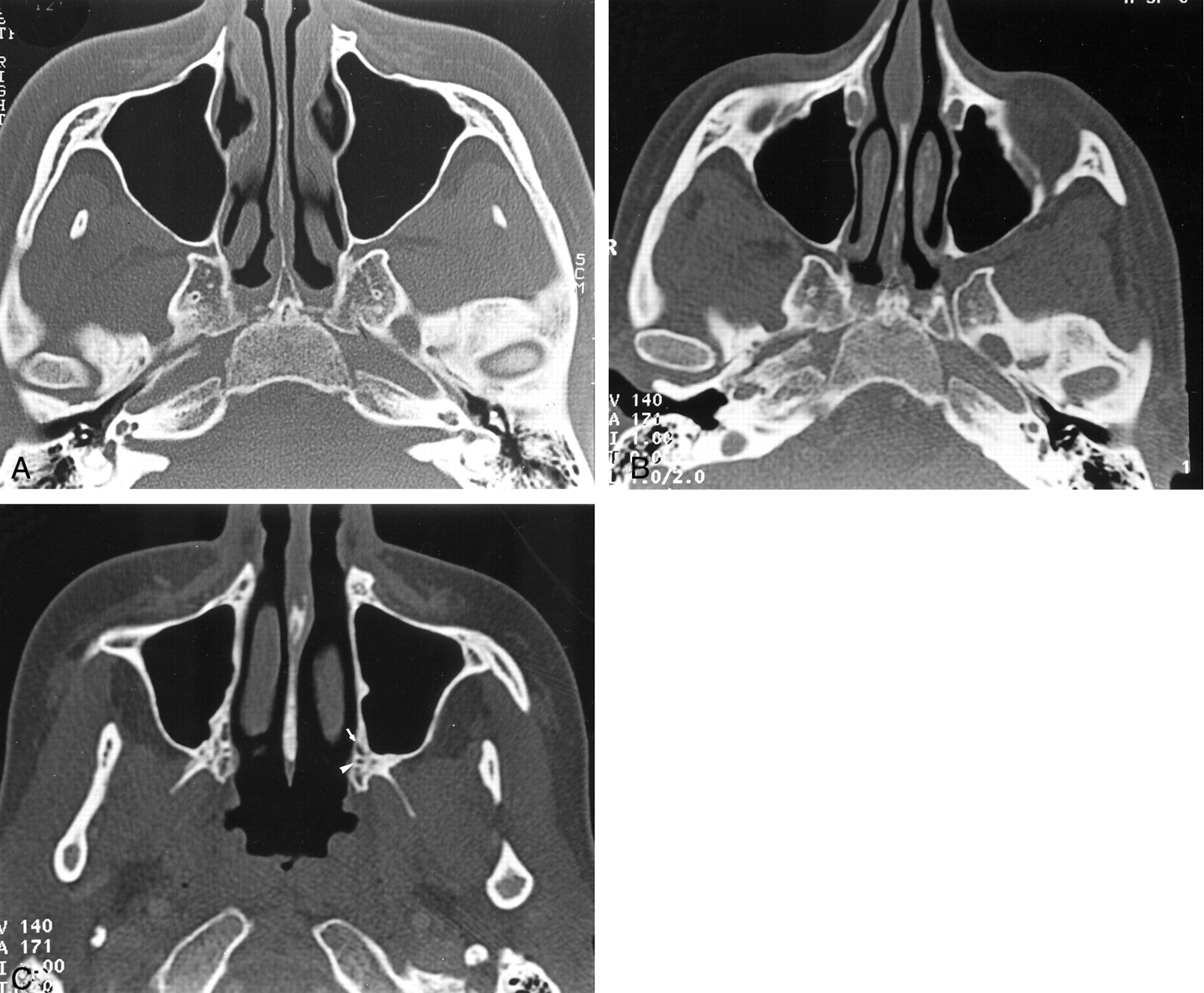 pterygopalatine foramen