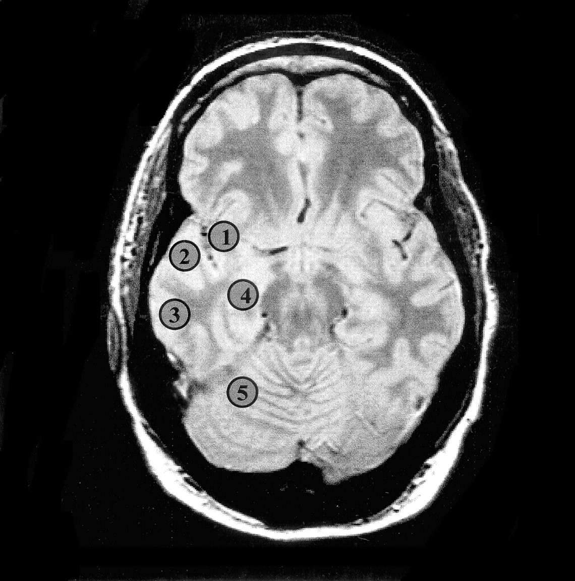 Mesial Temporal Lobe