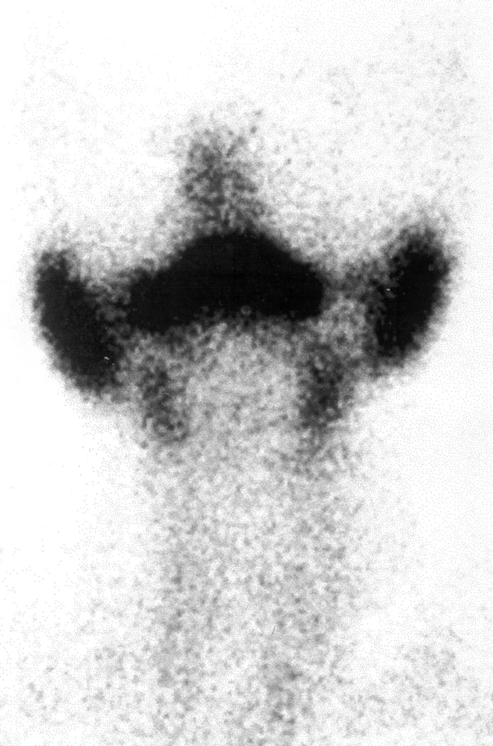 Radionucleotide Scan