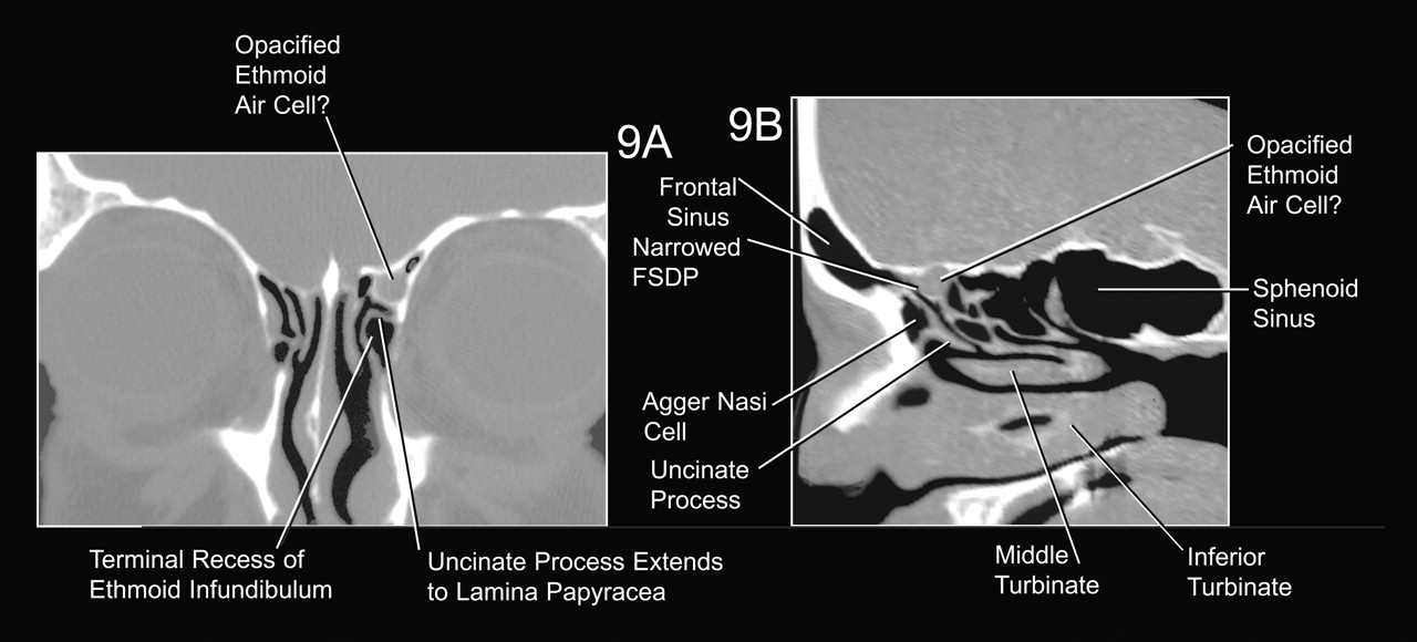 Opacified Sinus