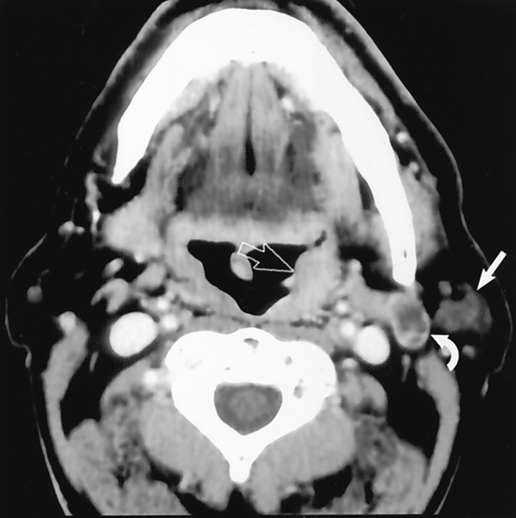 Parotid Masses