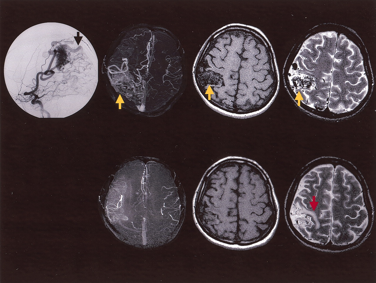 Cerebral Perfusion Imaging