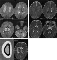 acute necrotizing encephalopathy