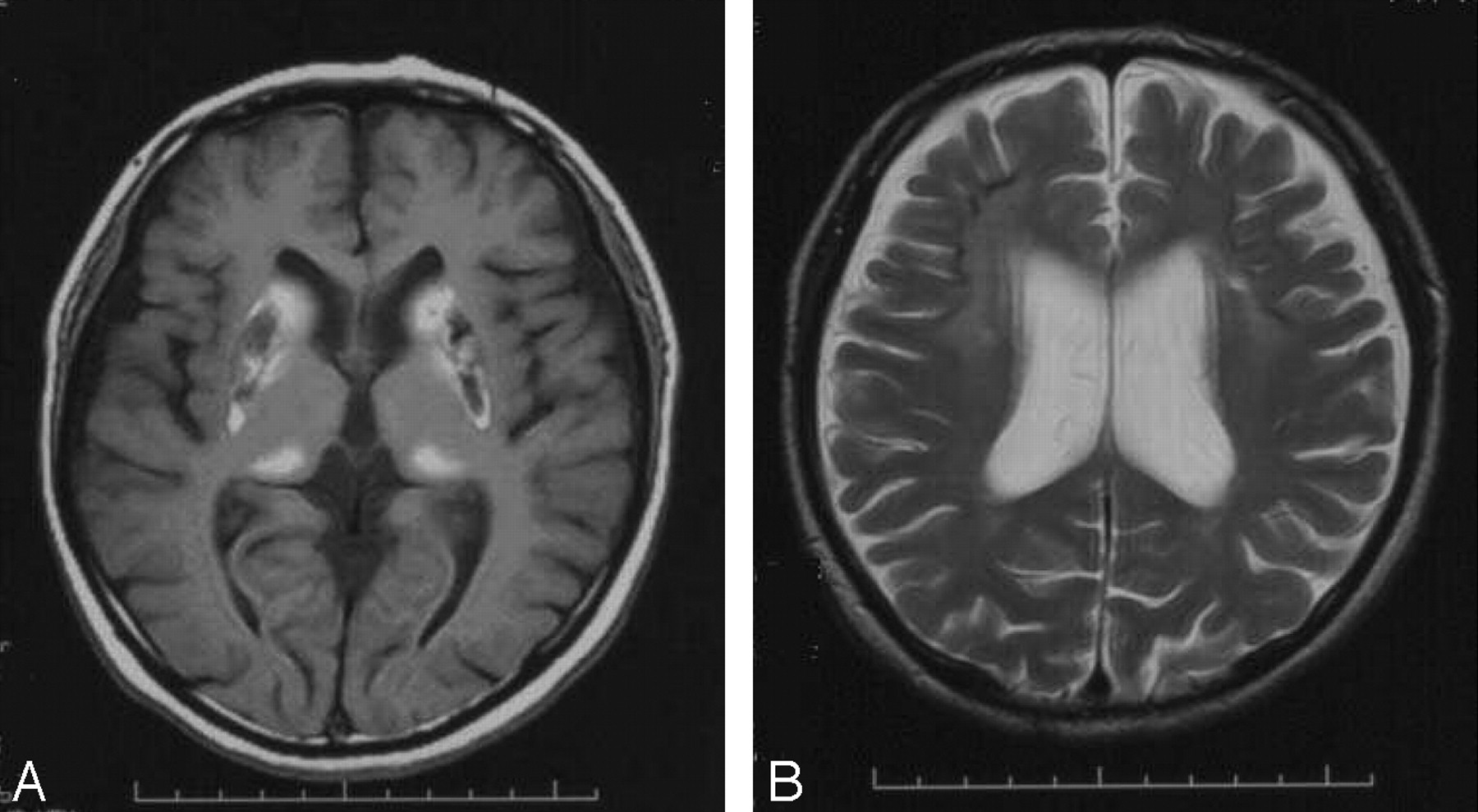 Fahr Disease