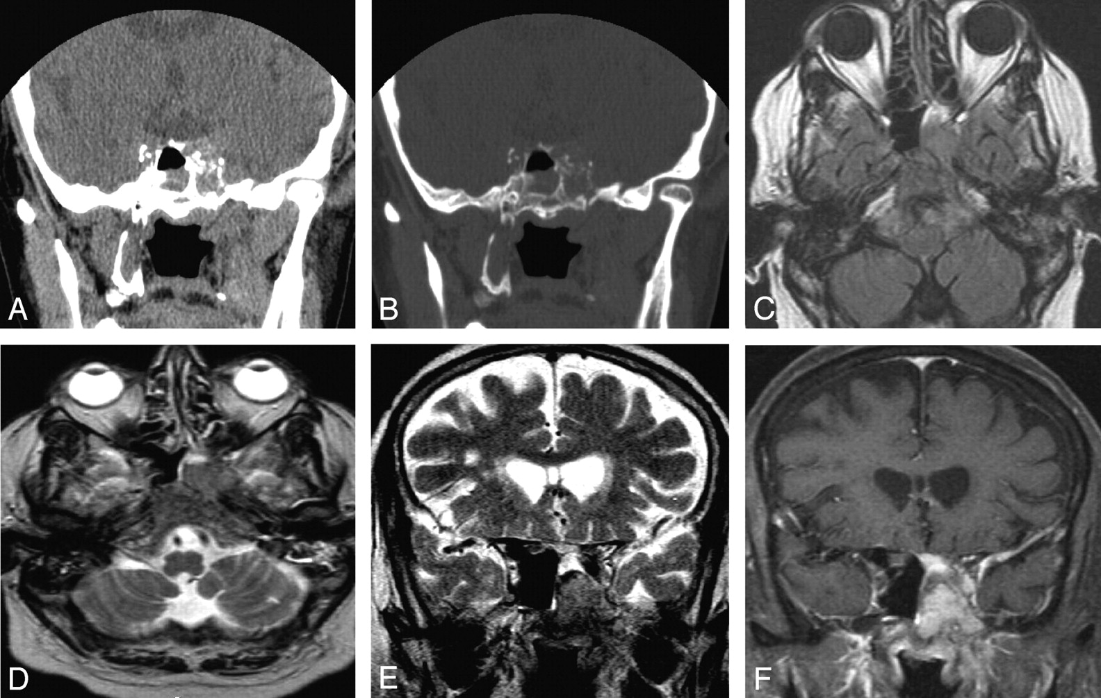 Mri Of Sinuses