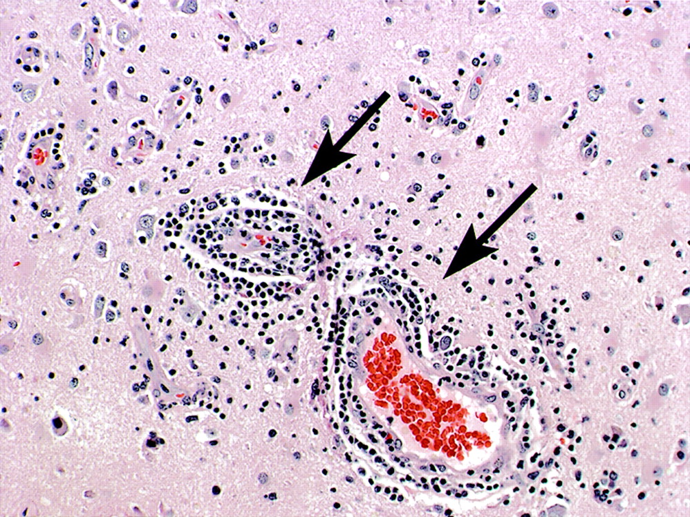 Lymphocytic Vasculitis