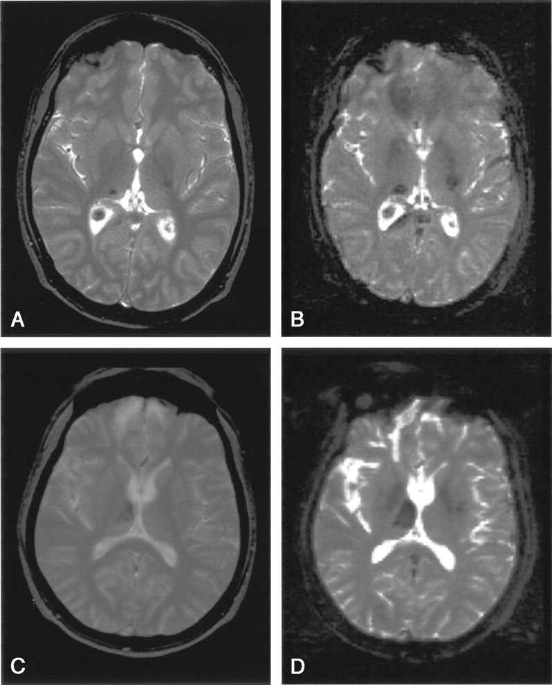 Brain Damage Mri