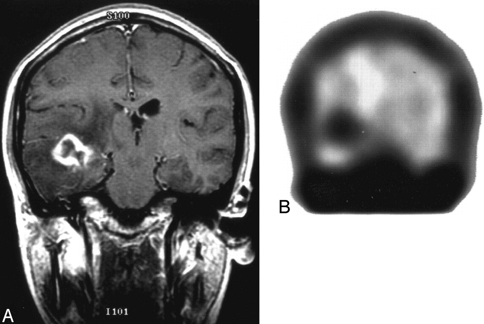 lymphoma brain