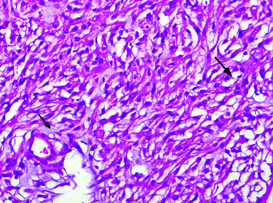 Chordoid Meningioma