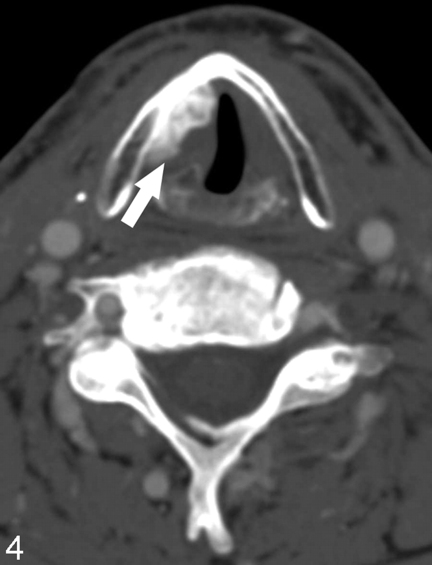 Vocal Cords Ct