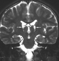 acute necrotizing encephalopathy