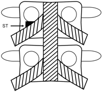 Safe triangle transforaminal epidural steroid injection