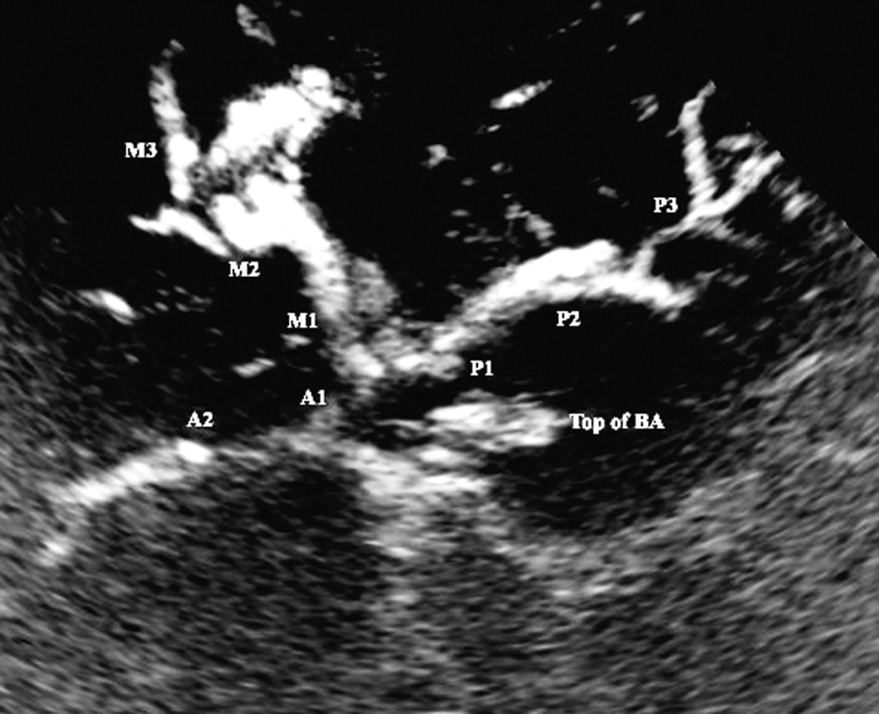 Ultrasound Brain