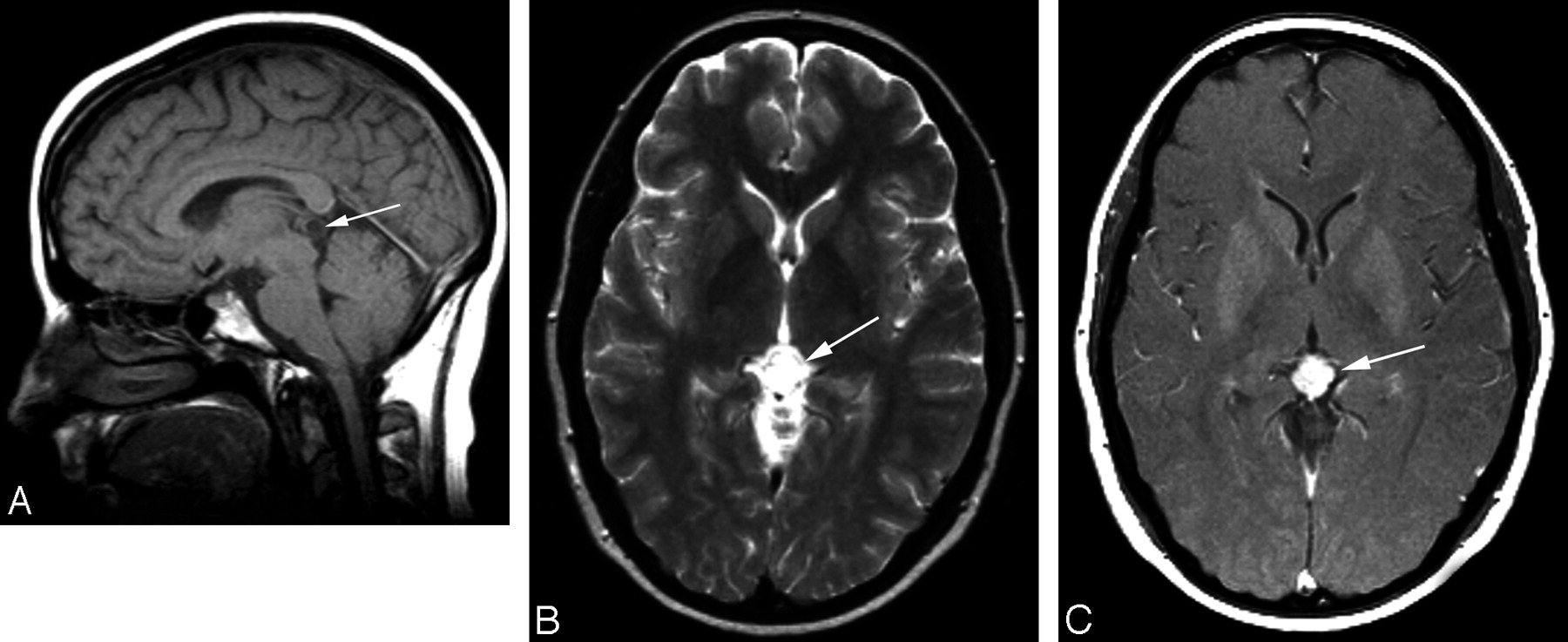 Fig 1 Pineocytoma Mimicking A Pineal Cyst On Imaging True Diagnostic Dilemma Or A Case Of Incomplete Imaging American Journal Of Neuroradiology