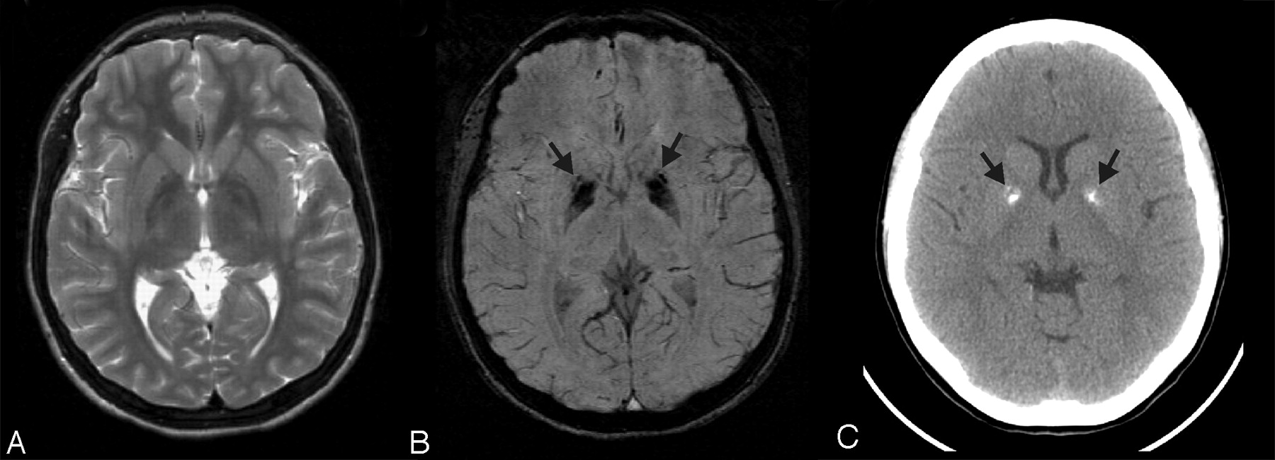 Fahr Disease