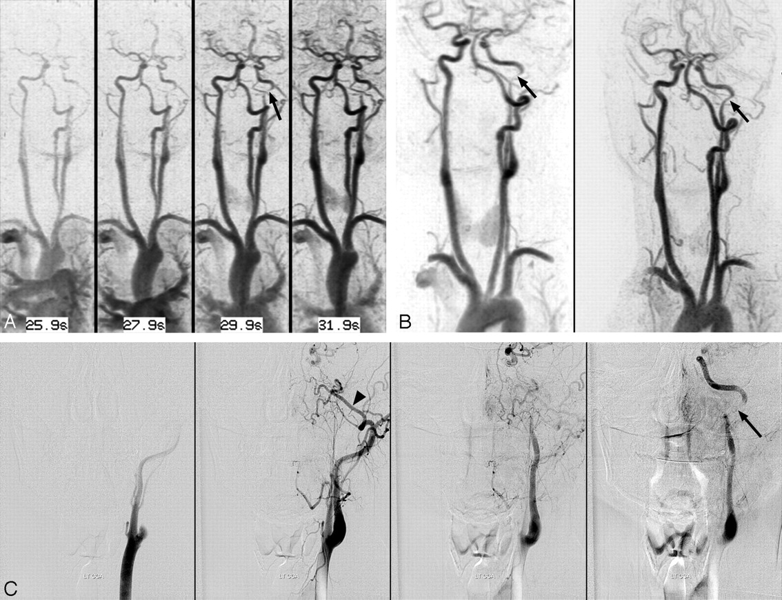 Inverted Neck Syndrome