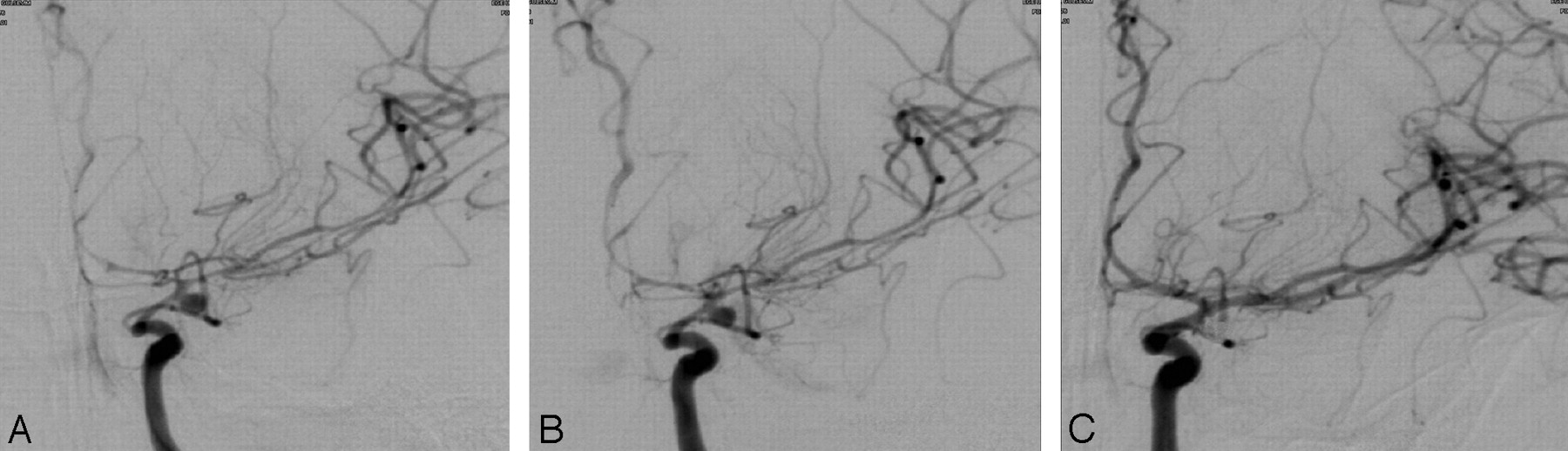 intra arterial