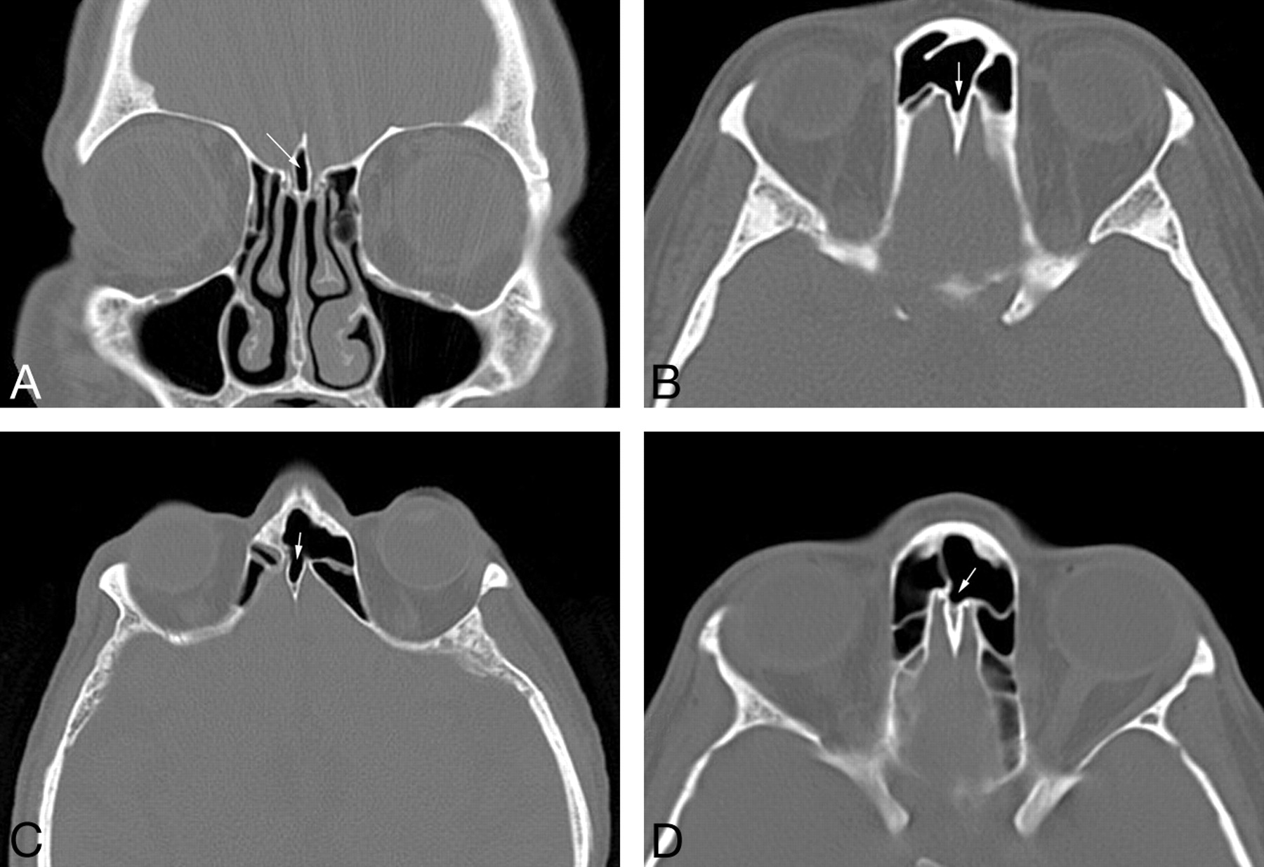 Ct Sinus