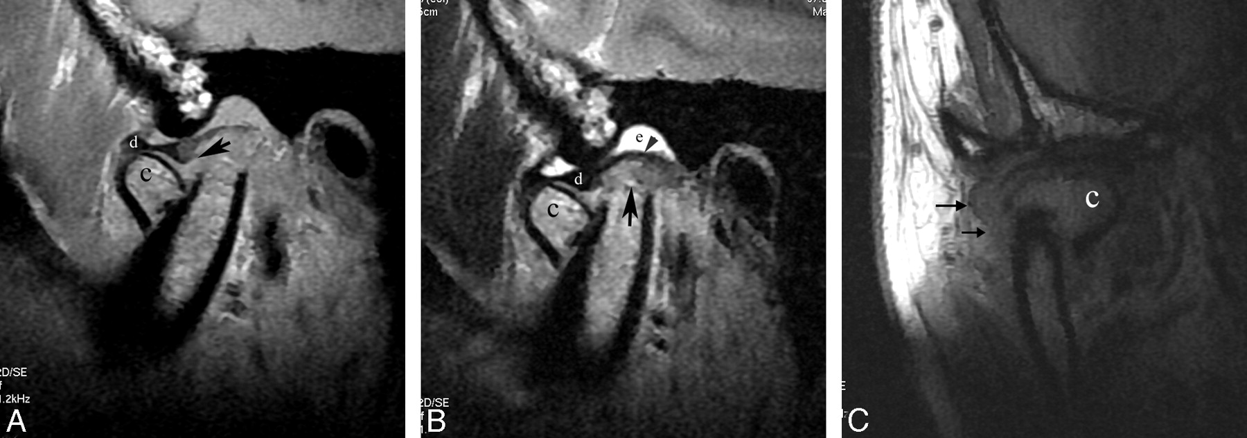 Condyle Fracture