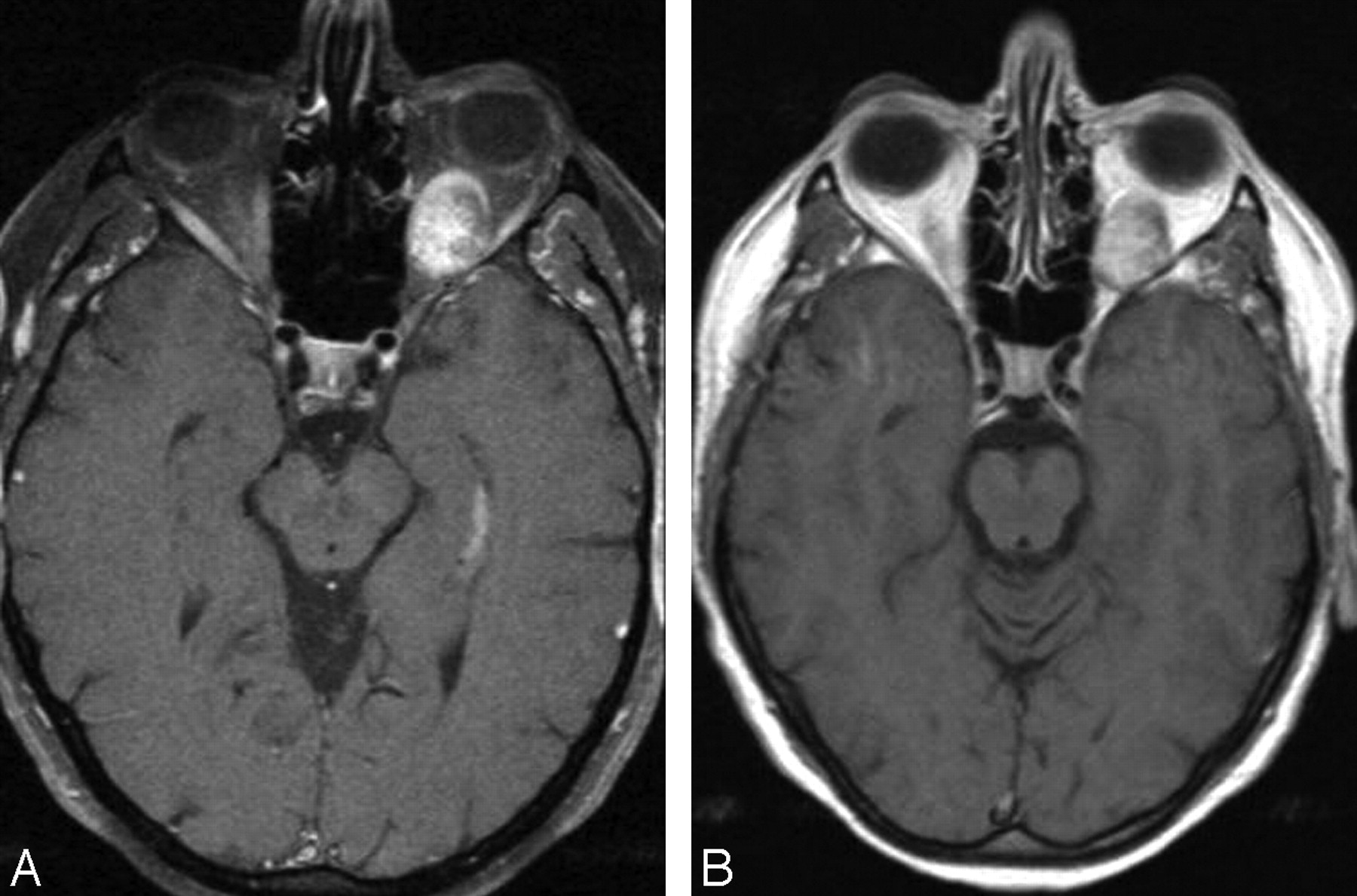 Cavernous Angioma