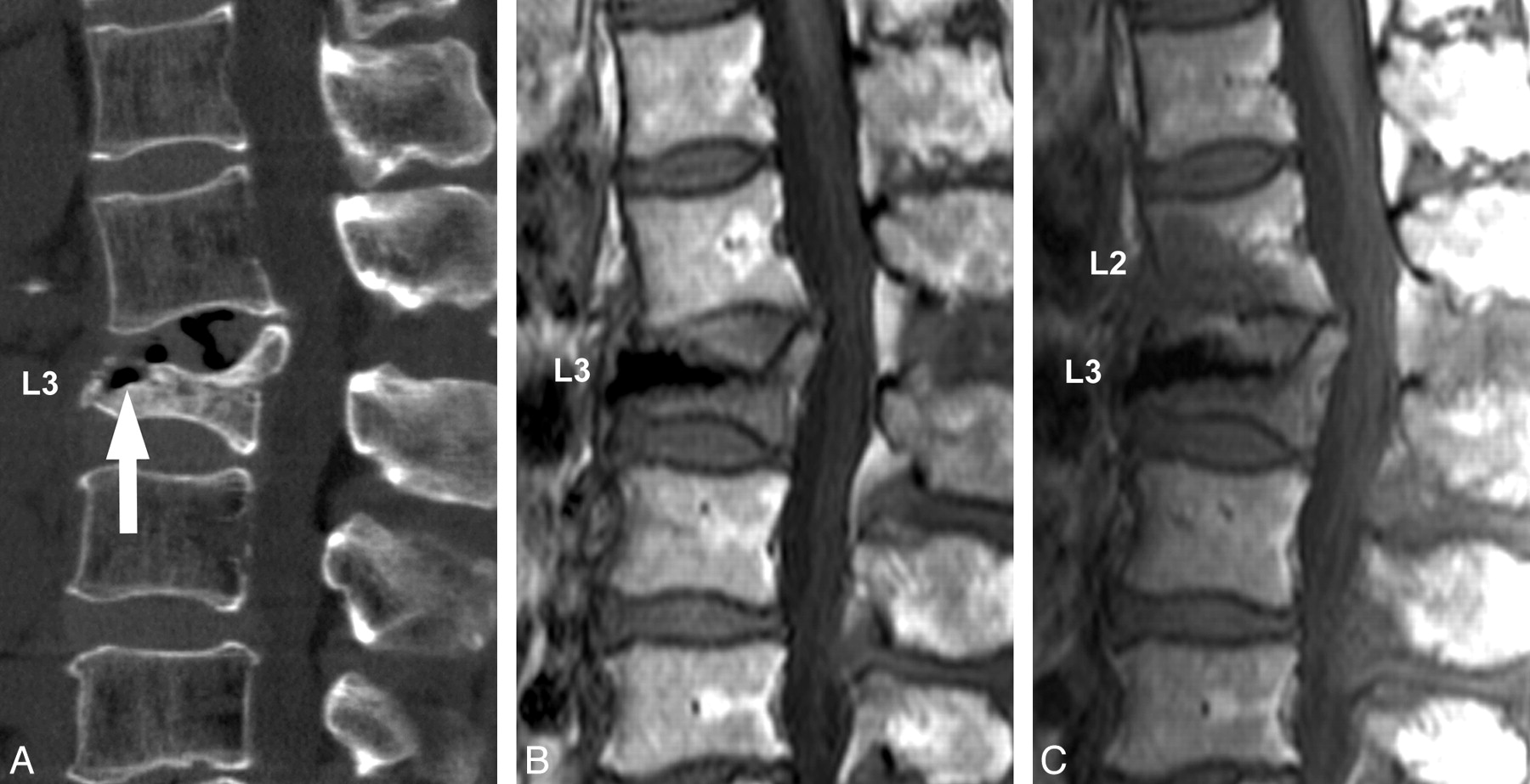 L3 Vertebral Fracture