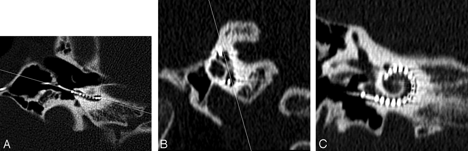 basal turn