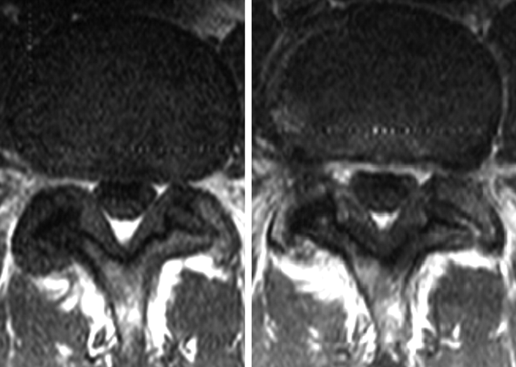 Fig 5 The Thickened Ligamentum Flavum Is It Buckling Or Enlargement American Journal Of Neuroradiology