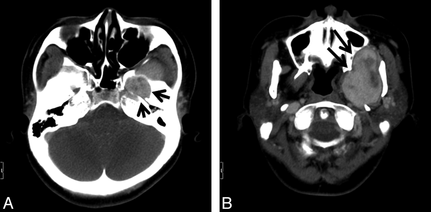 Ct Tumor