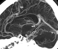 Falcine Sinus