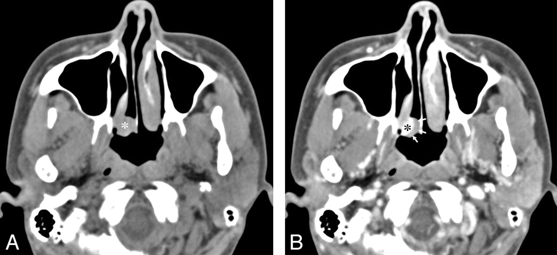 posterior choanae