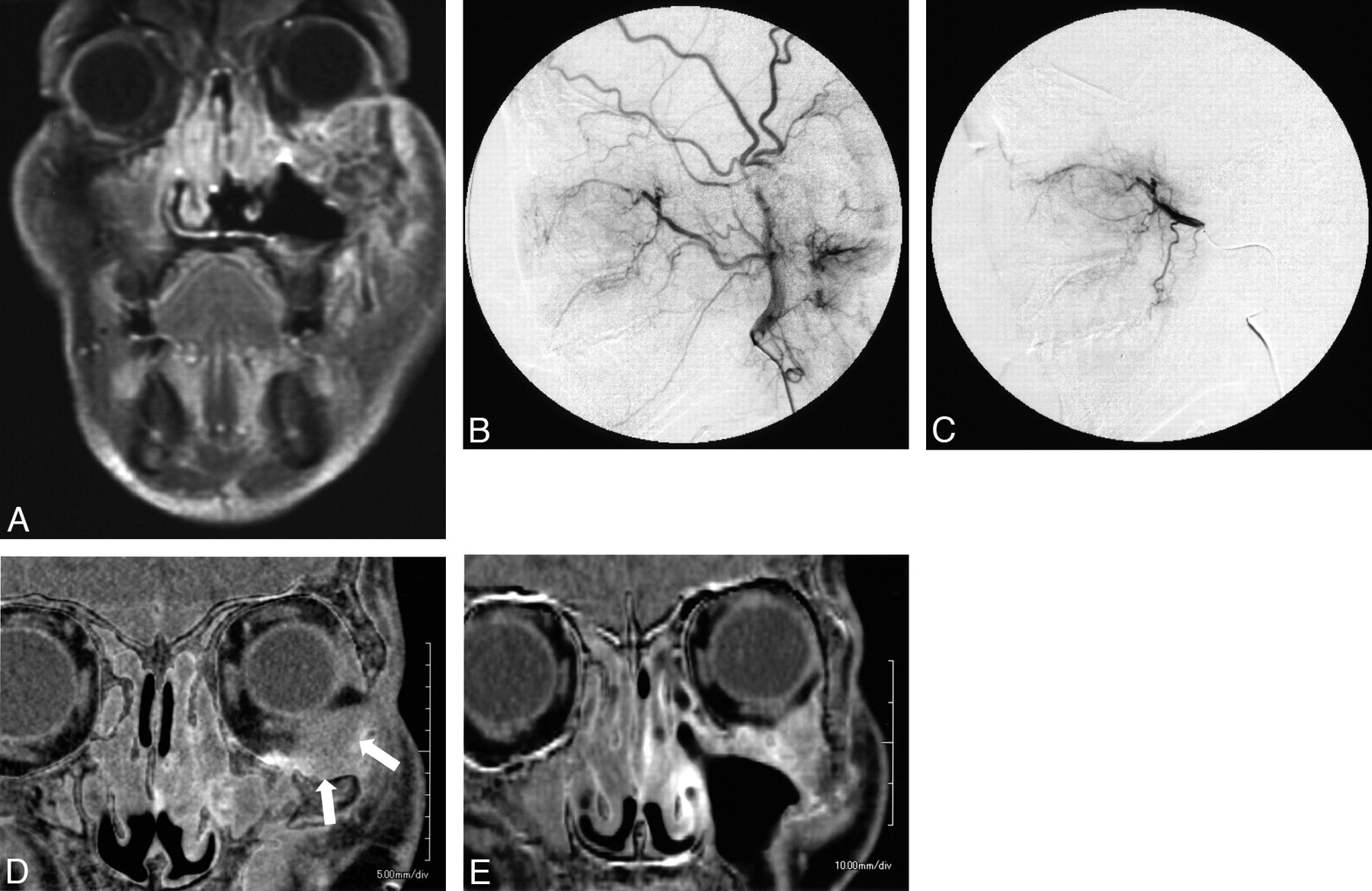 Maxillary Tumor