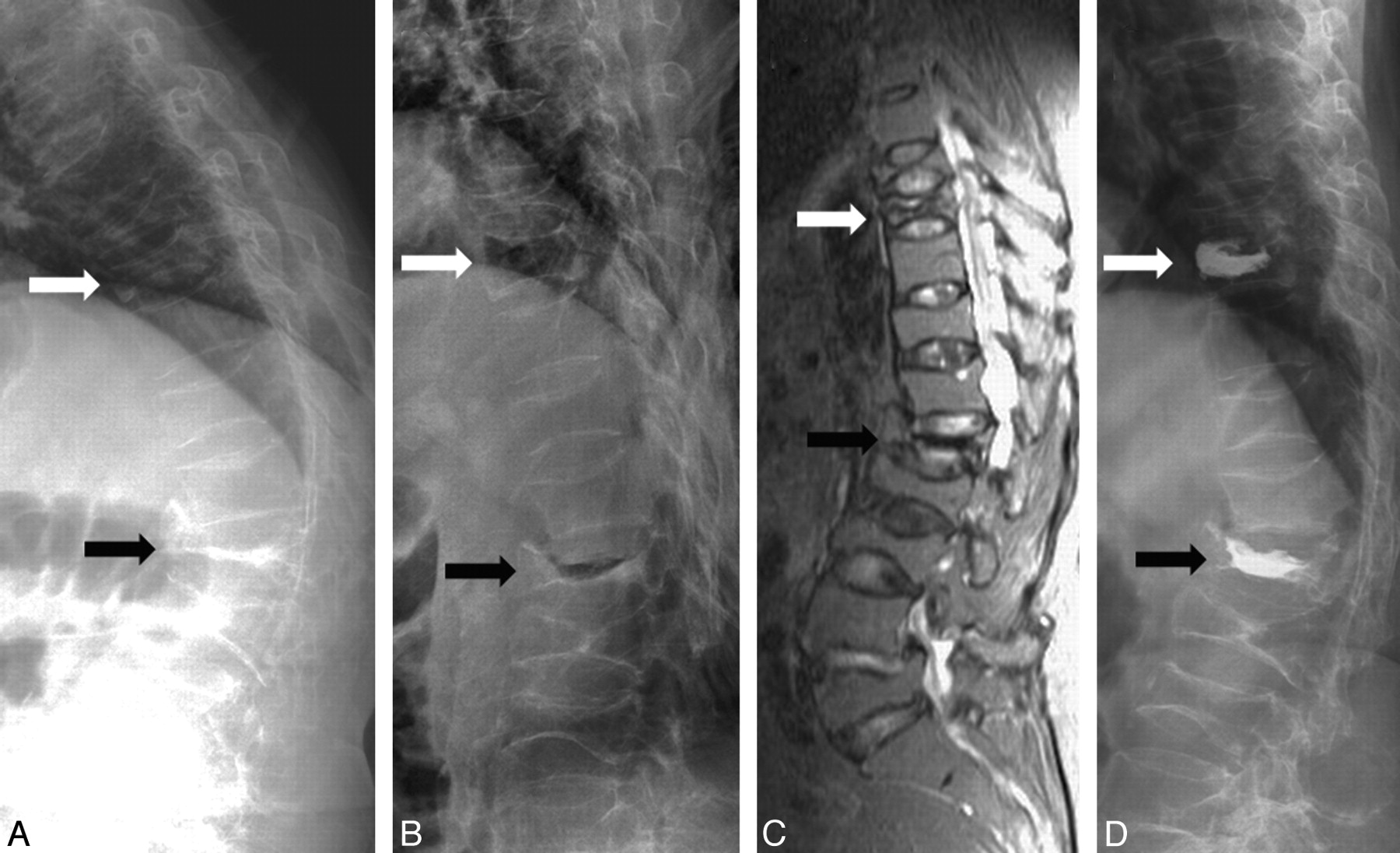 compression fracture l1