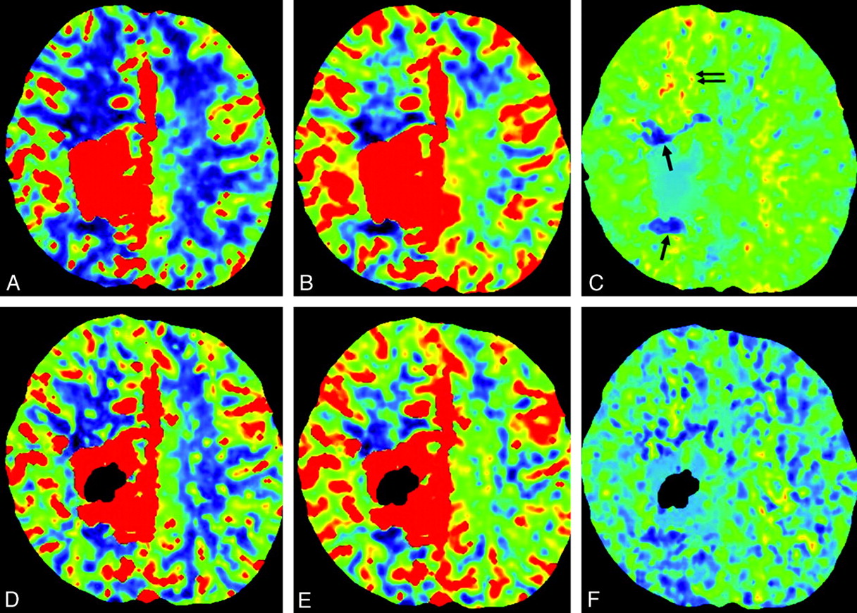 Brain Perfusion