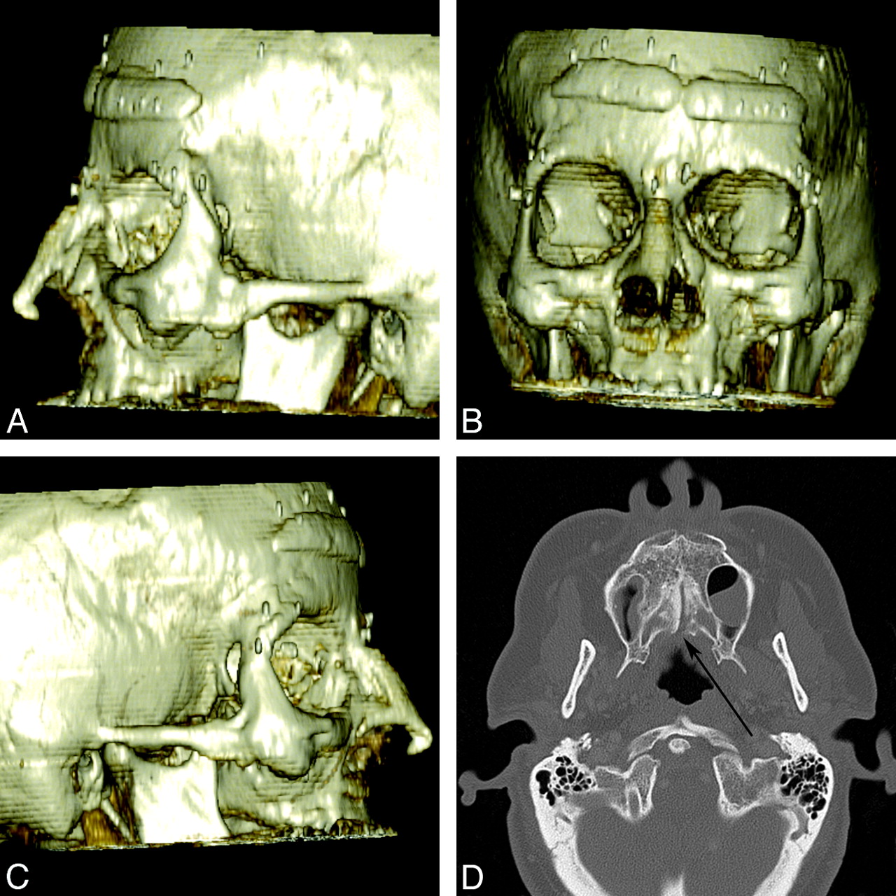 Anteverted Nares