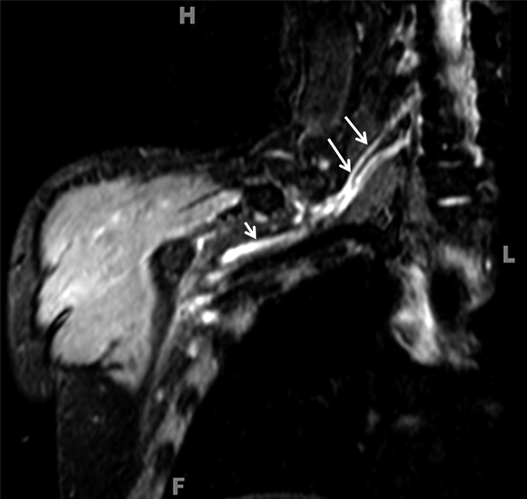 Brachial Radiculitis