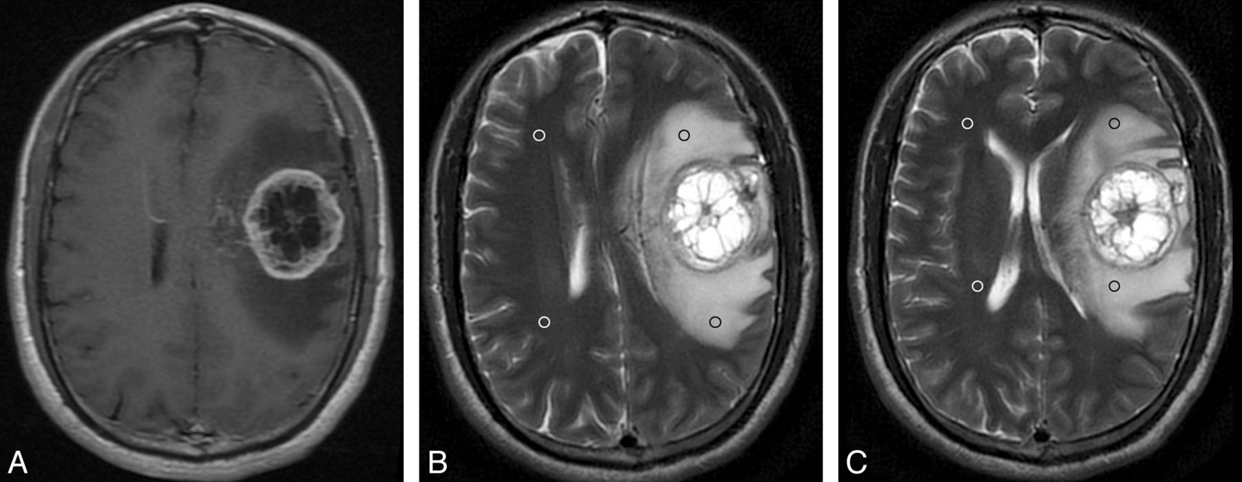 Glioblastoma Multiforme Pdf