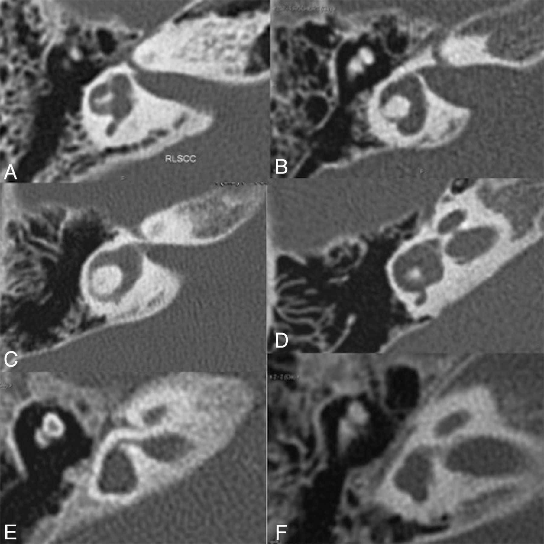 Fig 3 Spectrum Of Temporal Bone Abnormalities In Patients With Waardenburg Syndrome And Sox10 Mutations American Journal Of Neuroradiology