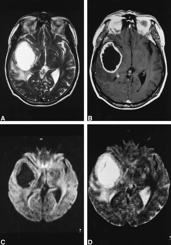Use Of Diffusion Weighted Mr Imaging In Differential Diagnosis Between