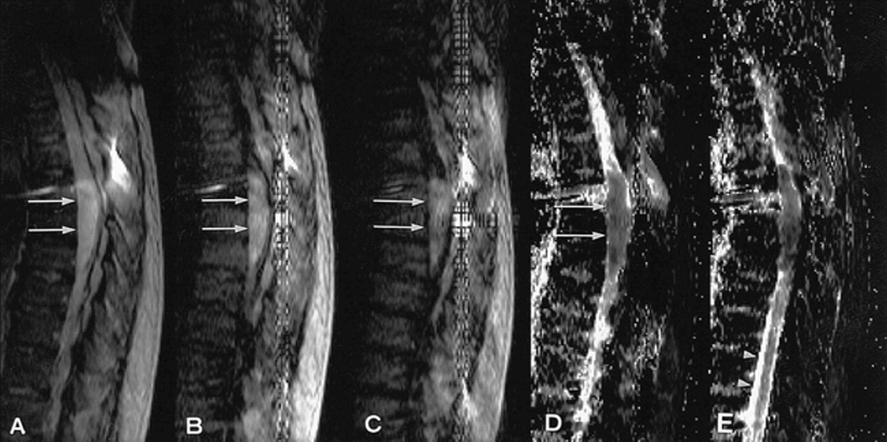 The Utility Of Diffusion Weighted Imaging With Navigator Echo Technique