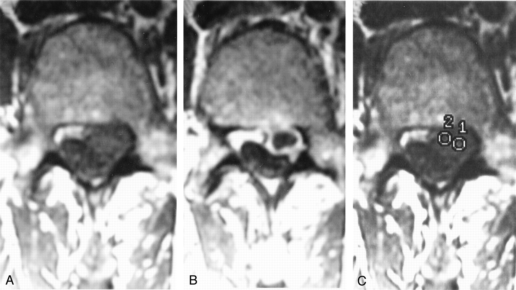 Contrast Between Scar And Recurrent Herniated Disk On Contrast Enhanced Mr Images American